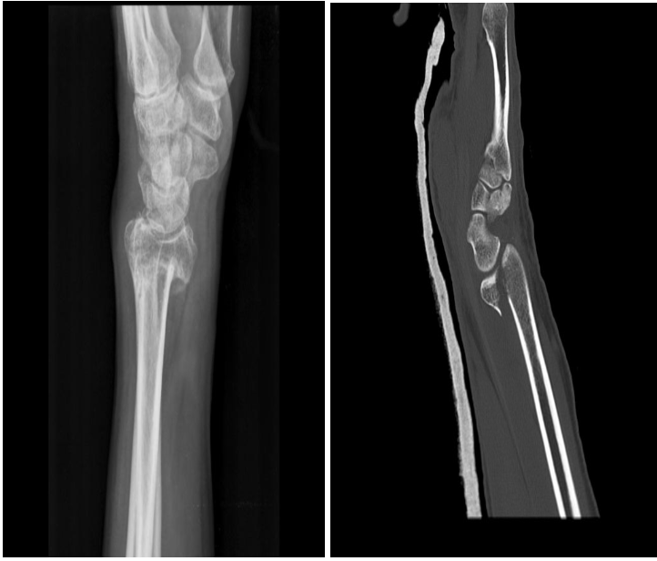 健康・医学 Distal Radius Fractures and Carpal Distal Radius Fractures - Colles - Smiths - Barton - TeachMeSurgery